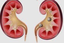 Photo of क्या आपको भी है किडनी स्टोन के दोबारा लौटने का डर?